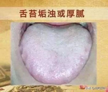 ​舌苔白腻该怎么办 舌苔白腻怎么调整