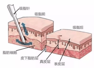 ​大腿吸脂后多久恢复正常 大腿吸脂后多久彻底消肿