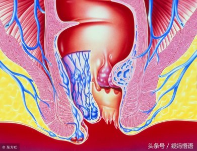 ​孕期肛门处突现小肉球，原来这个情况很普遍，快来看看怎么一回事